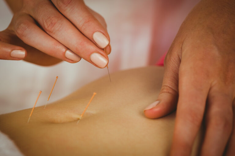 Young woman getting acupuncture treatment in therapy room
